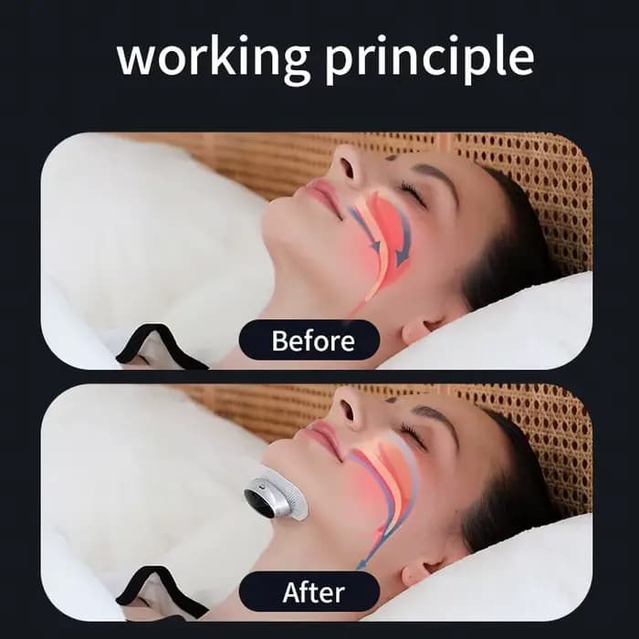 Dispositif anti-ronflement à stimulation à double impulsion - Soulagement de l'apnée du sommeil