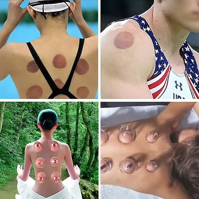 Ensemble de thérapie par ventouses sous vide