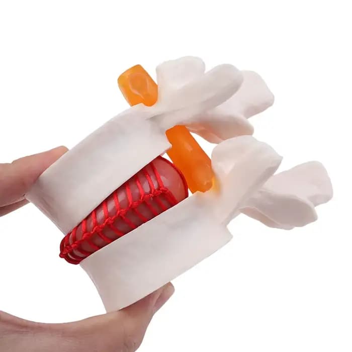 Modèle pédagogique d'anatomie humaine : squelette, colonne vertébrale, hernie discale lombaire, cerv