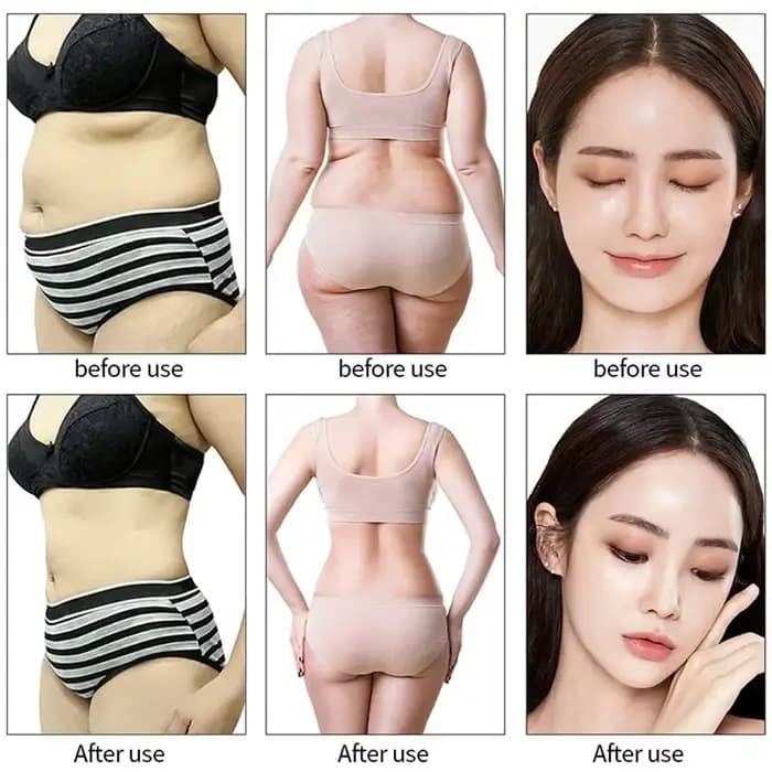 Lifting de la peau RF par cavitation Lipolaser